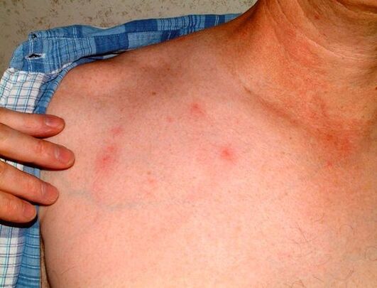 Symptomer vu Parasiten ënner der Haut